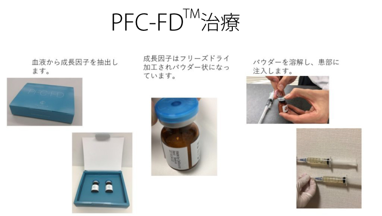 PFC-FDTM療法の手順