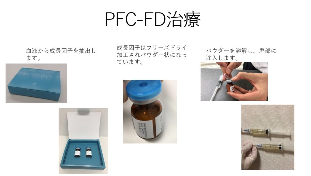 PFC-FD療法の流れ