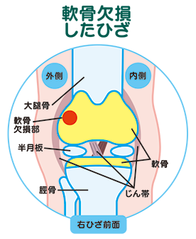 軟骨欠損したひざ